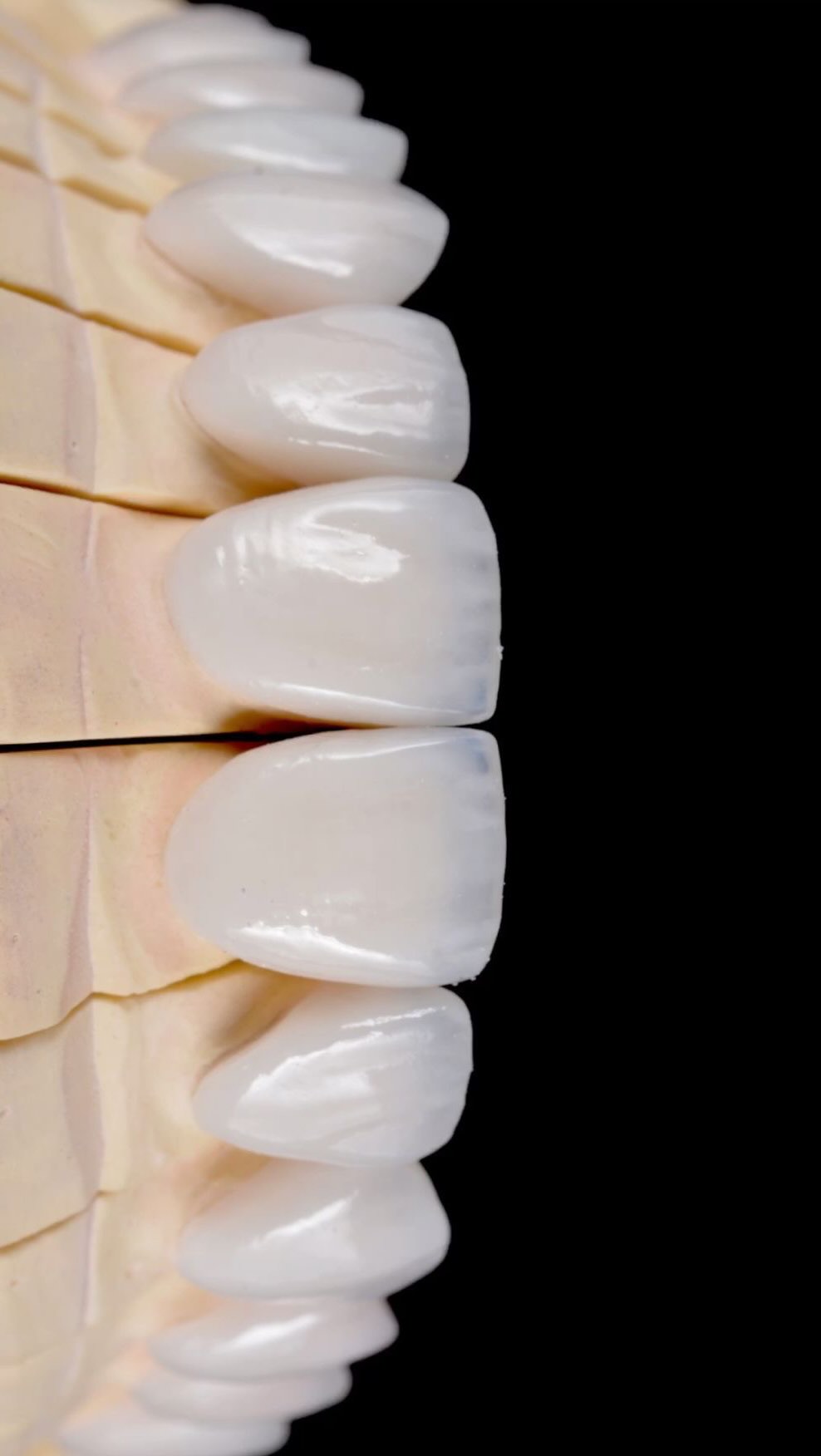 Diseño de Sonrisa — carillas de porcelana de alta estética